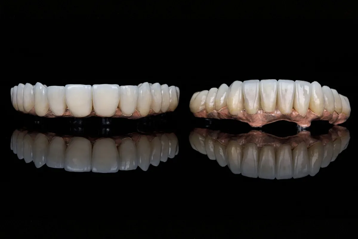 Bursa E-Max Veneer: Lithium Disilicate Processes and Features